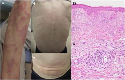 A case of VEXAS syndrome (vacuoles, E1 enzyme, X-linked, autoinflammatory, somatic) with decreased oxidative stress levels after oral prednisone and tocilizumab treatment